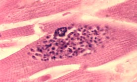 Toxoplasmosis