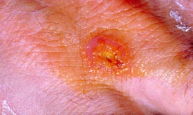 tularemia infection