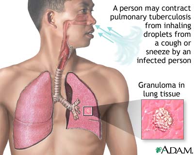 What are some of the first signs of tuberculosis?