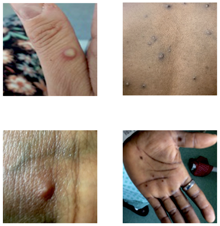Mpox blisters