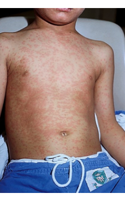 HP Measles 1.jpg