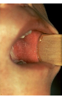 HP Measles 3.jpg