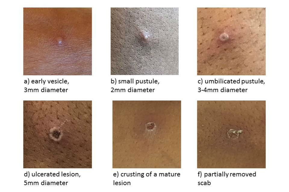 Monkeypox sores at different stages: raised spots, blisters filled with fluid, scabs.